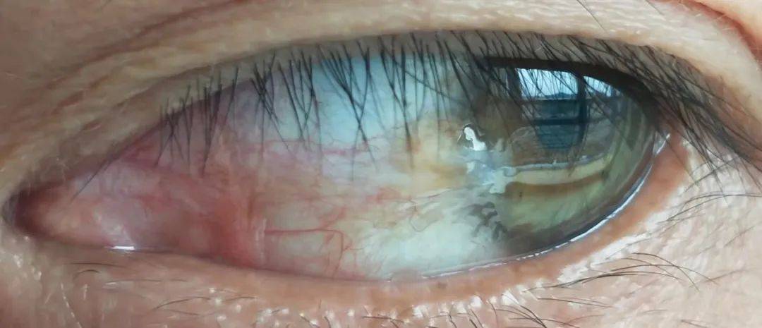 当心"眼睛的翅膀"——翼状胬肉_发病_治疗_结膜