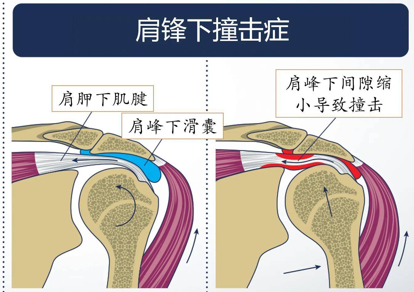 右肩示意图图片