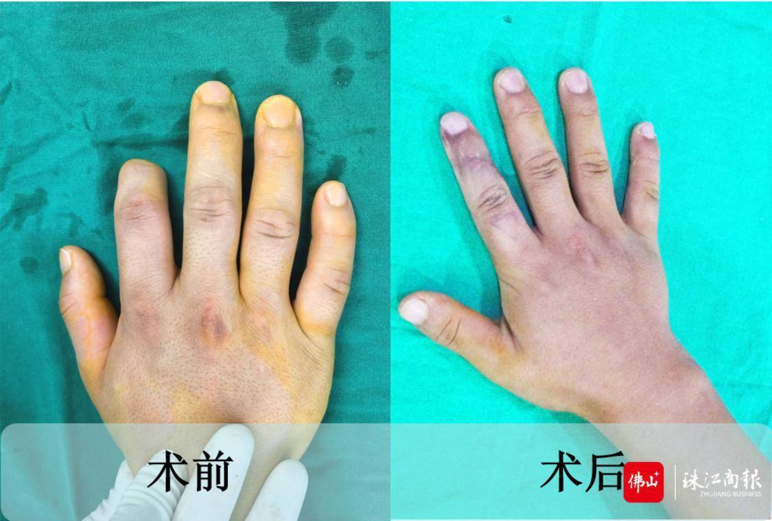 一般是"足趾搬家",也就是"拆东墙补西墙",取一个脚拇指再造一个手指