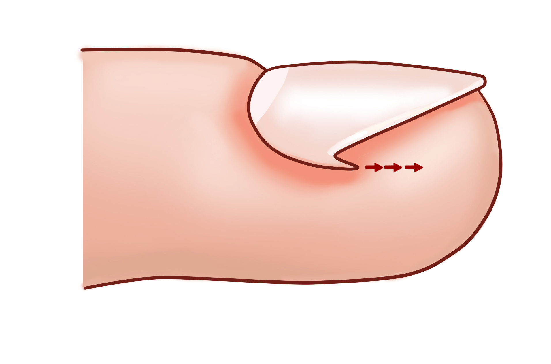 以上人群容易导致局部损伤裂开,有时看似微不足道的伤口也足以为细菌