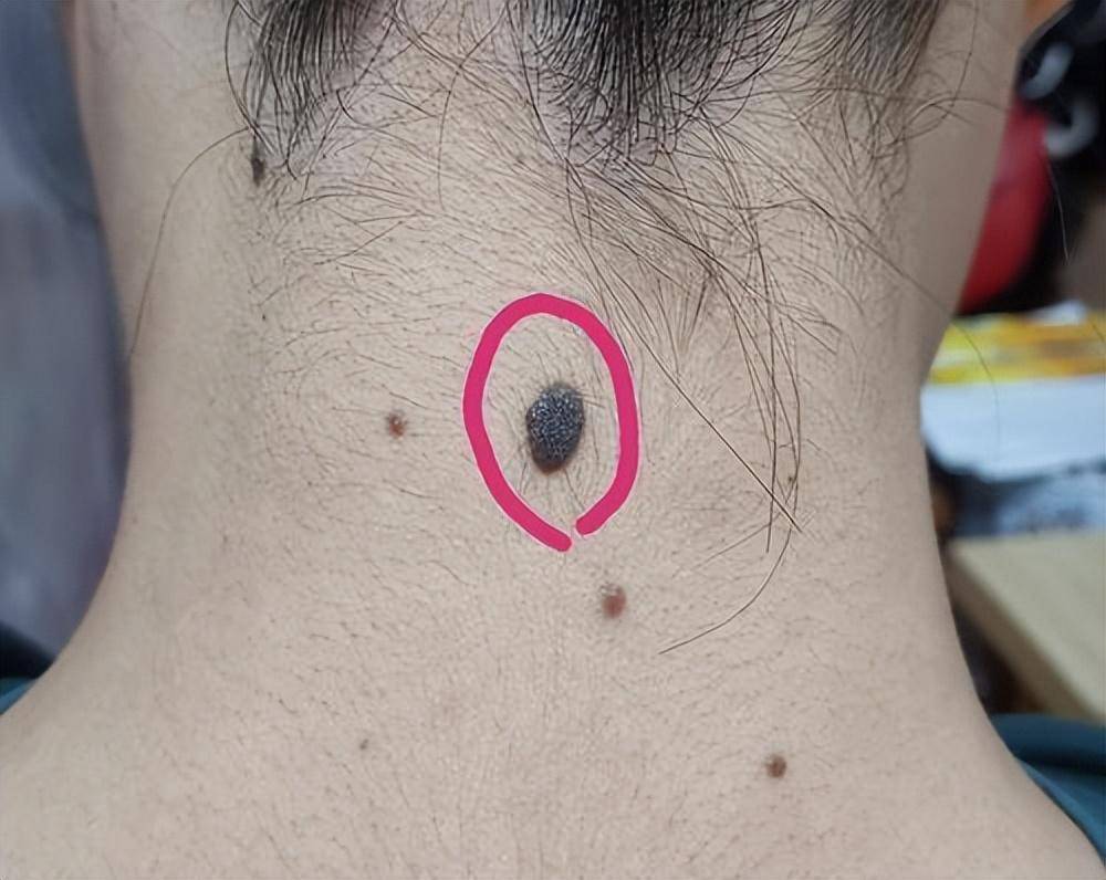 医生提醒:如果黑痣长在这3个部位,或要提高警惕_身体_表面_黑色