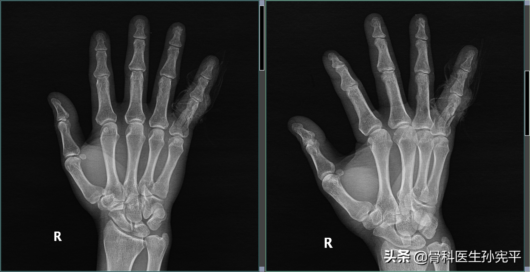 诊断:右手小指近节指骨骨折;左手第3,4掌骨头,第5掌骨基底骨折病例4