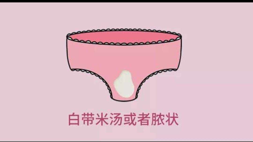 等到宫颈癌后期,癌组织溃破,坏死的组织会导致感染,此时的白带就会以