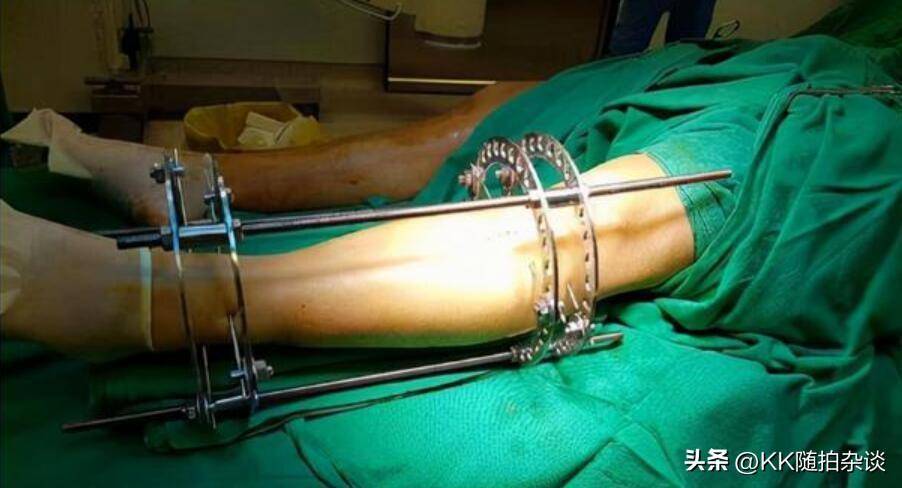 神秘的"断骨增高术",其实很简单,帮你再长高10cm不是梦_手术_身高