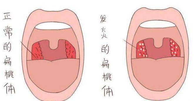 口腔炎症 脾胃图片