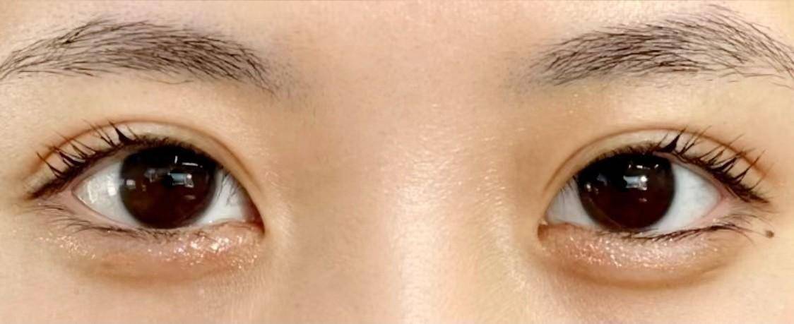 做完双眼皮后整个眼睛变得炯炯有神_皮肤_眼球_位置