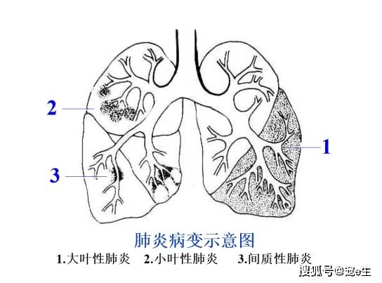 传入侧支性抑制示意图图片