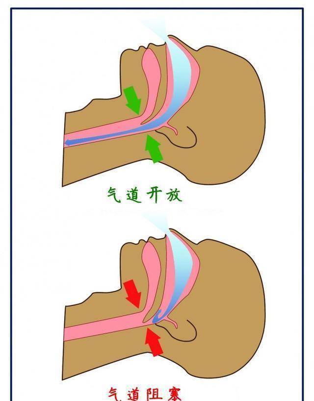 我们经常忽略的12种呼吸系统疾病的关键标志_肺部_症状_情况
