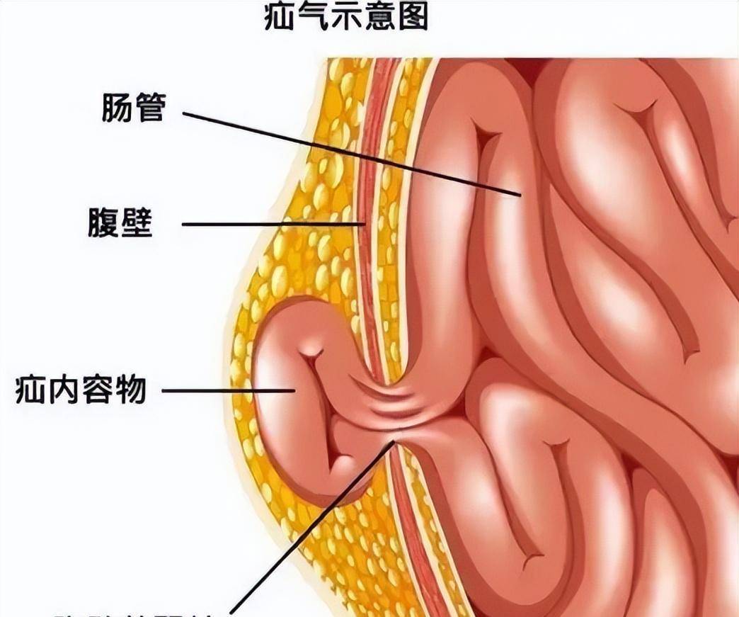 疝气病就医指南 看这篇总结就够了!- 三甲医生推荐_手术_检查_麻醉