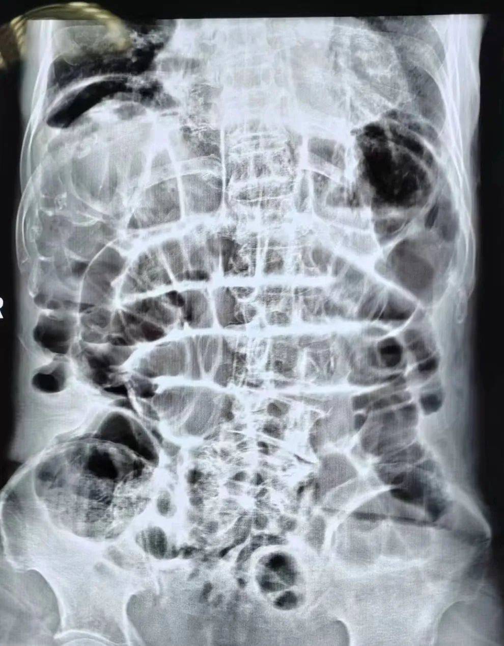 耄耋老人突发小肠穿孔 怀远上和医院外科及时手术保平安