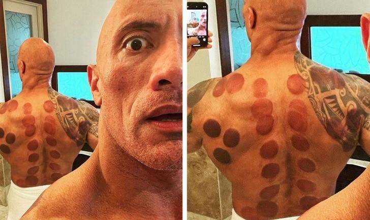 世界8位名人拔罐,中医流传国外,很吃香也很挣钱!_疗法_治疗师_东方