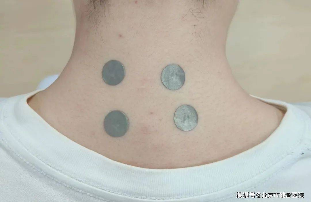 健康科普 | 皮内针治病痛,您了解吗?_方法_经络_疾病