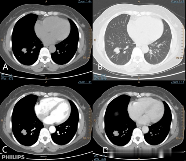 不規則的肺結節一定是肺癌嗎?pet ct=真相!_病變_玻璃_顯示