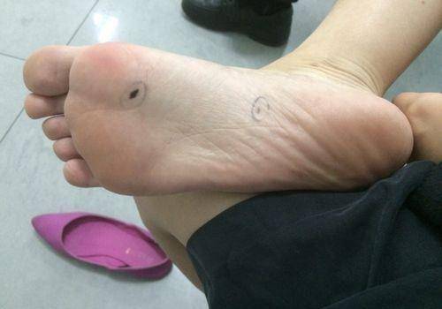 得比较大,或者逐渐变大以及颜色不正常,就算没有长在脚底也要引起重视