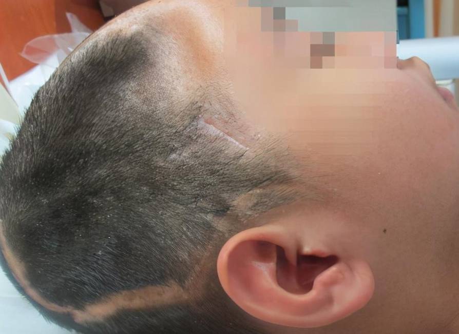 脑外伤术后偏瘫和脑脊液鼻和耳漏,腰大池引流又致难治性颅内感染_治疗