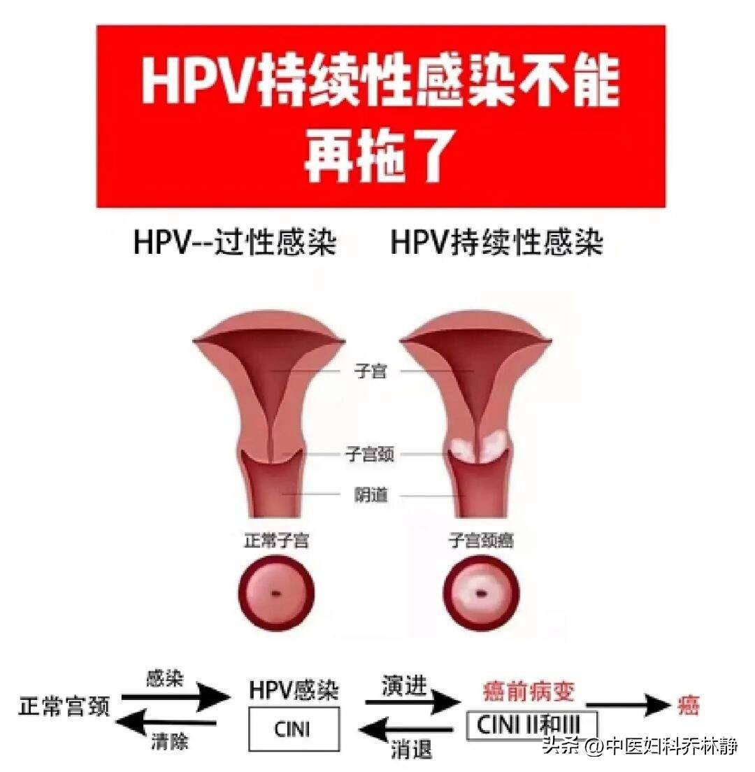 hpv感染后出现这些症状要及时做宫颈病筛查