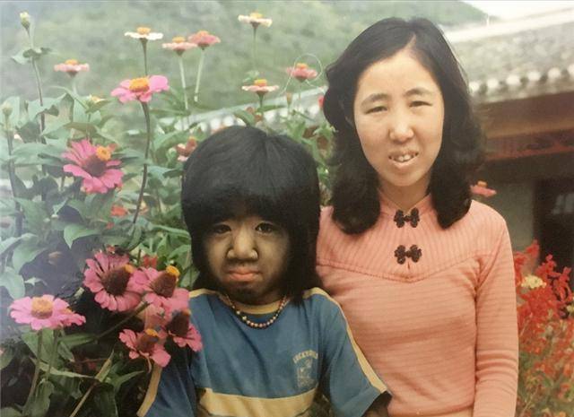 "毛孩"于震寰:浑身是毛,刚出生就被研究,41岁迎娶90后娇妻_孩子_毛发