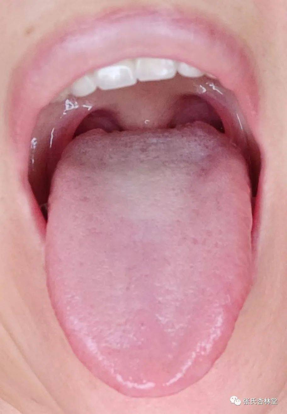 拍舌苔的示例照片图片