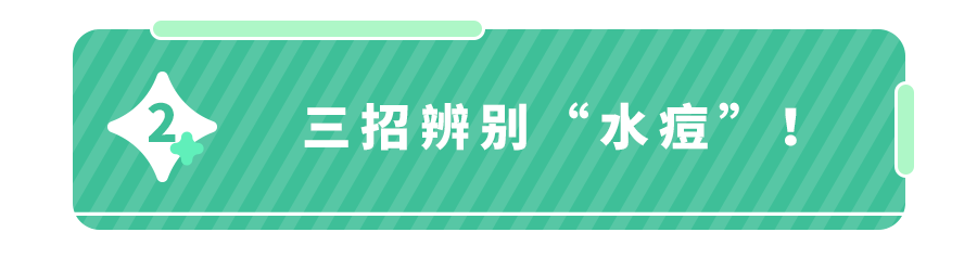 宝宝需要打水痘疫苗吗 怎么判断是不是得了水痘