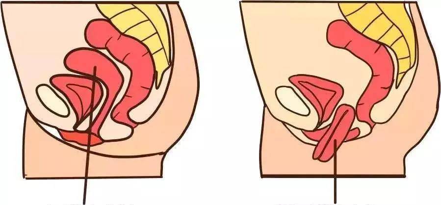 女性如何远离这种"社交病"_阴挺_阿姨_阴道