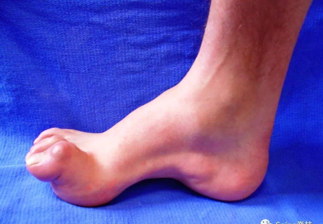 charcot-marie-tooth病 (腓骨肌萎缩症)_箭头_疾病_神经