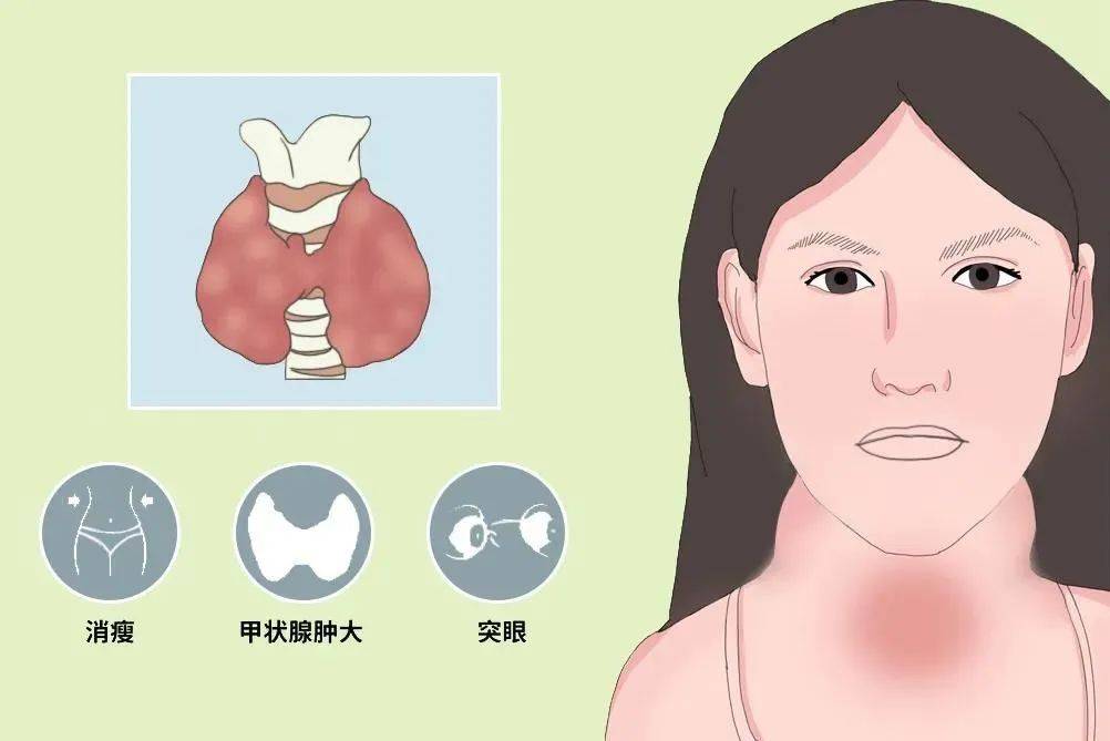 工作压力大,或是甲亢诱因!