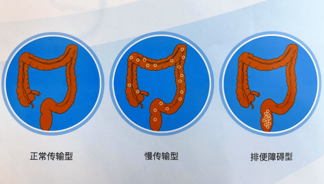 西安慢性便秘检查:结肠慢运输试验检查怎么做?_传输_方法_诊断