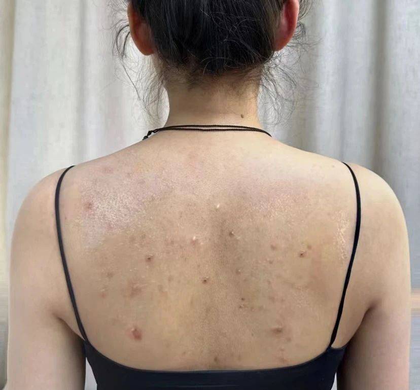 后背出油严重,痘痘一片接一片?给你支一招,30天轻松恐怖祛痘!