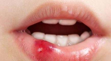 口唇发干,红肿痒痛,严重者发生脱屑,甚至引起口周炎症及口唇过敏症