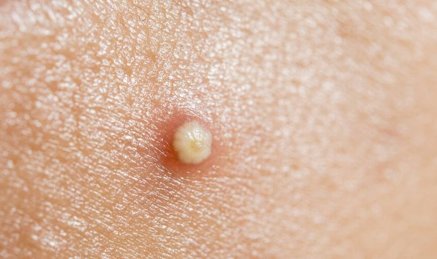 私处长痘千万别抠,可能是尖锐湿疣_痘痘_外阴_疙瘩