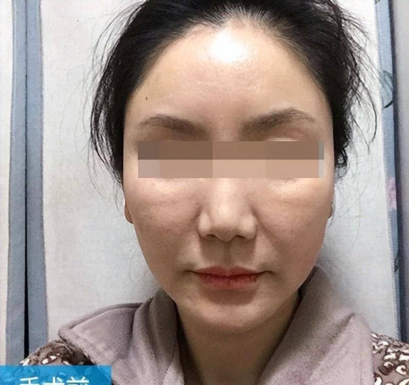 42岁黄女士把拉皮手术做了