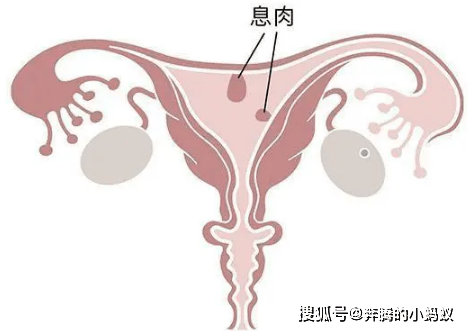 子宫息肉报告单图片