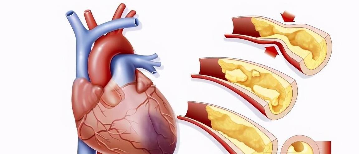 其實所描述的就是冠心病的發病機理與潛在不良後果.