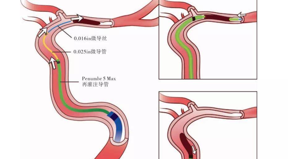 想要预防心梗,必须做好这些事_血管_血液_药物
