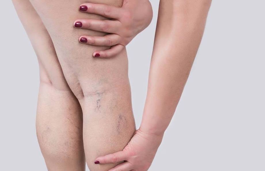 大象腿有救了,成千上万因脂肪水肿的女性可能会接受抽脂手术_艾米丽