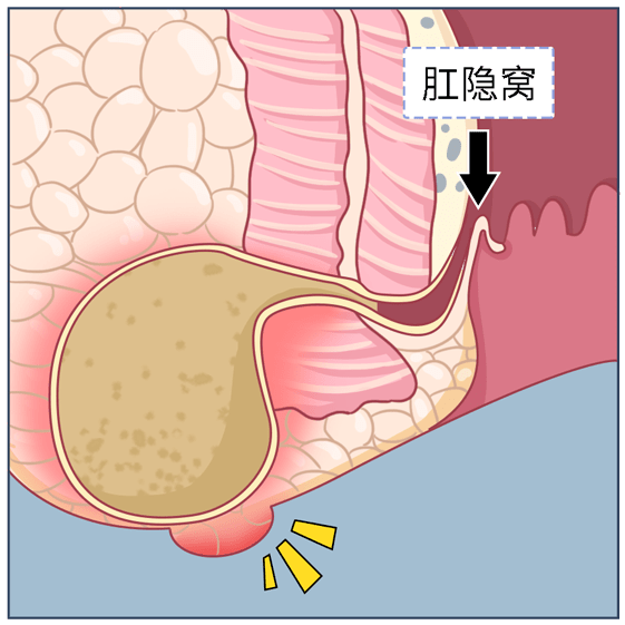 屁股長包塊硬硬的凸起疼,可能是肛周膿腫要當心!_肛門_局部_肛瘻