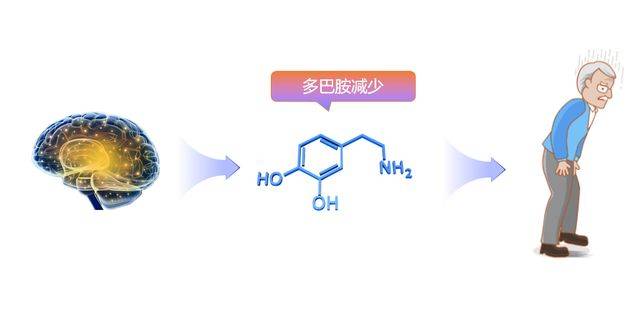 聊聊左旋多巴与它的"铁粉们"_药物_帕金森_药学会