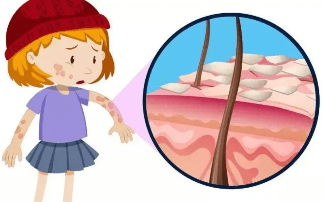 干性湿疹最管用的湿疹解决办法！-干性湿疹如何治