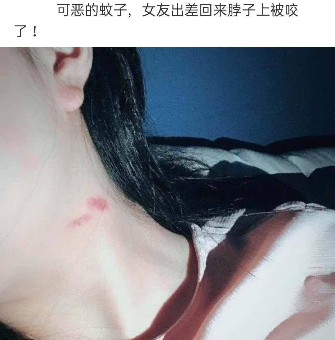 你说你女朋友脖子上的草莓状红印记是出差回来被蚊子咬的,如果你真