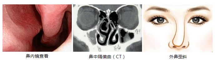 鼻中隔血腫:因鼻中隔軟骨膜間出血所致.