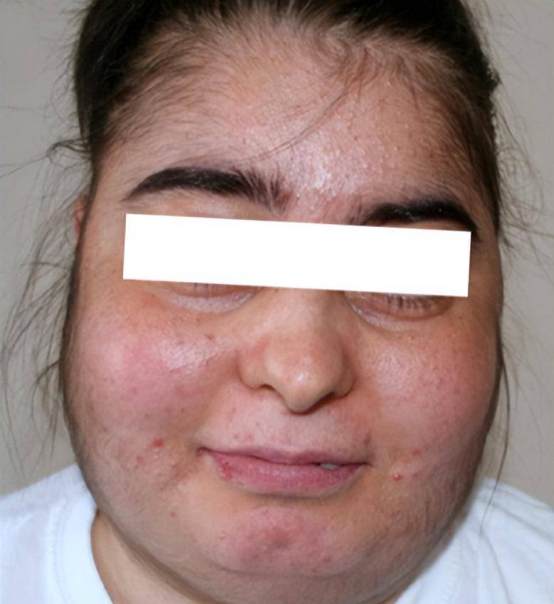 这种面部呈圆形,状如满月的脸型被称为"满月脸", 而导致它出现的原因