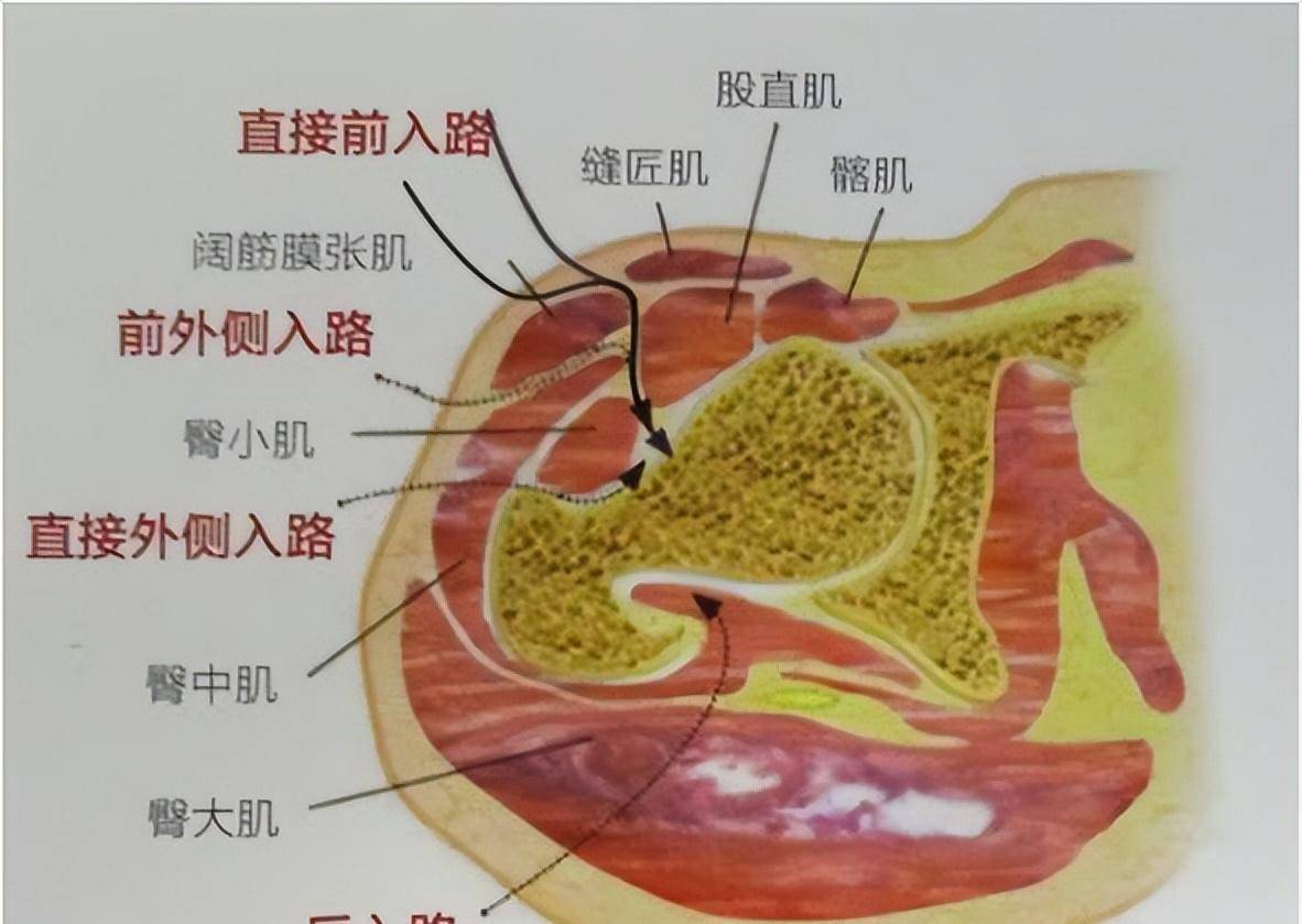 带你走进微创全髋关节置换术_手术_切口_并发症