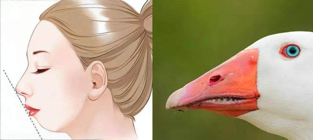 下巴后缩又称下颌后缩,主要表现为下颌颏部形态短小或处于相对靠后的