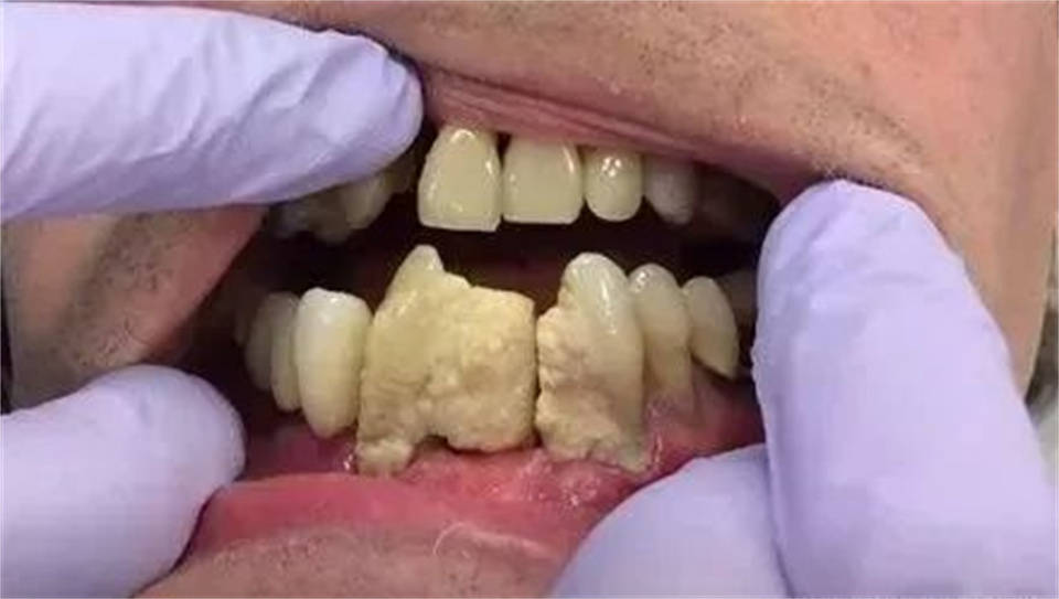 刚开始我是去洗牙来解决这个问题的,的确当时就能把牙结石清除干净