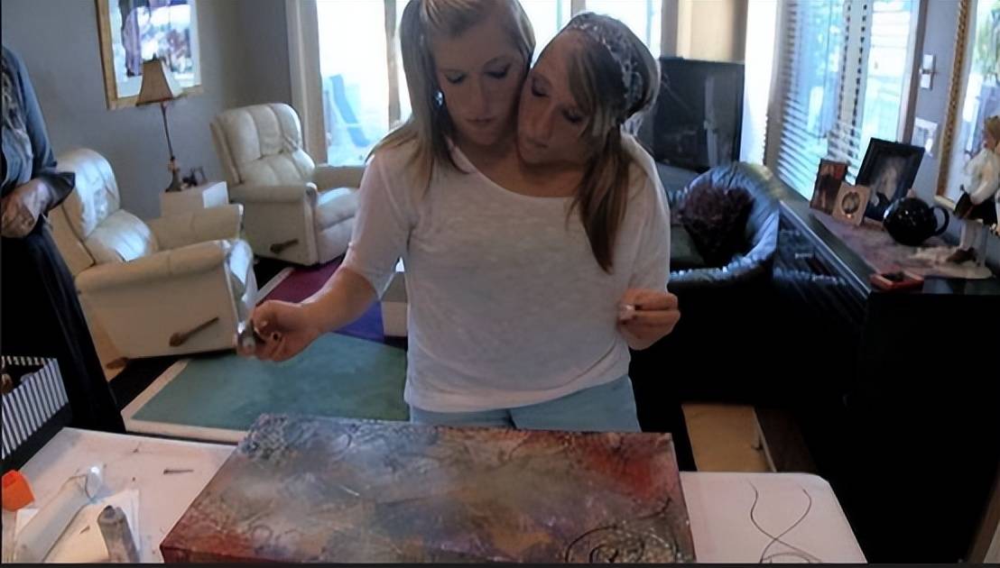 67最诡异的双头连体人,两个大脑如何控制同一个身躯?