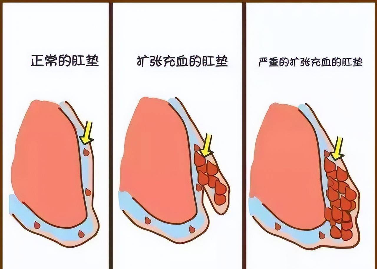 得了痔疮就一定要割以永治吗?