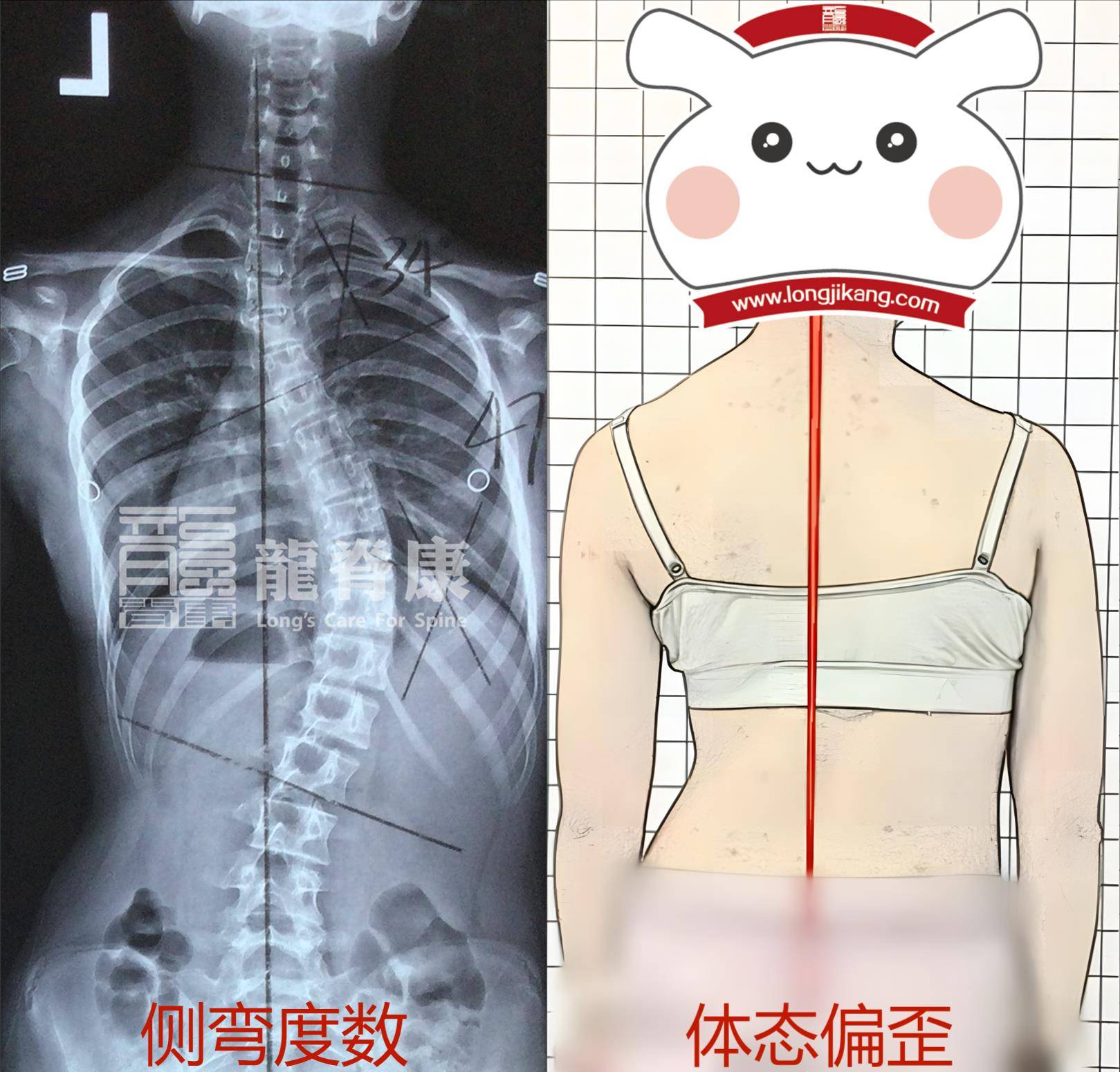 高达47°,此时体态已经有很明显的偏歪,弯腰时剃刀背向右边凸起明显
