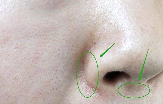 鼻翼两侧挤出的"白色东西",是什么?是螨虫分泌物吗?