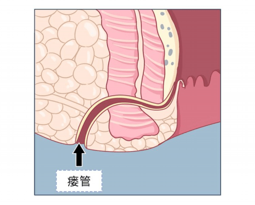 广东民安肛肠医院科普 肛瘘不做手术好不好能自然愈合吗?