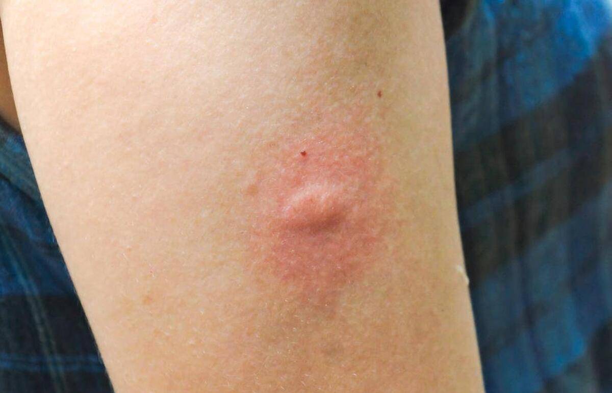 尽管蠓虫叮咬通常只导致短期的瘙痒和不适,但在某些情况下,它们可能